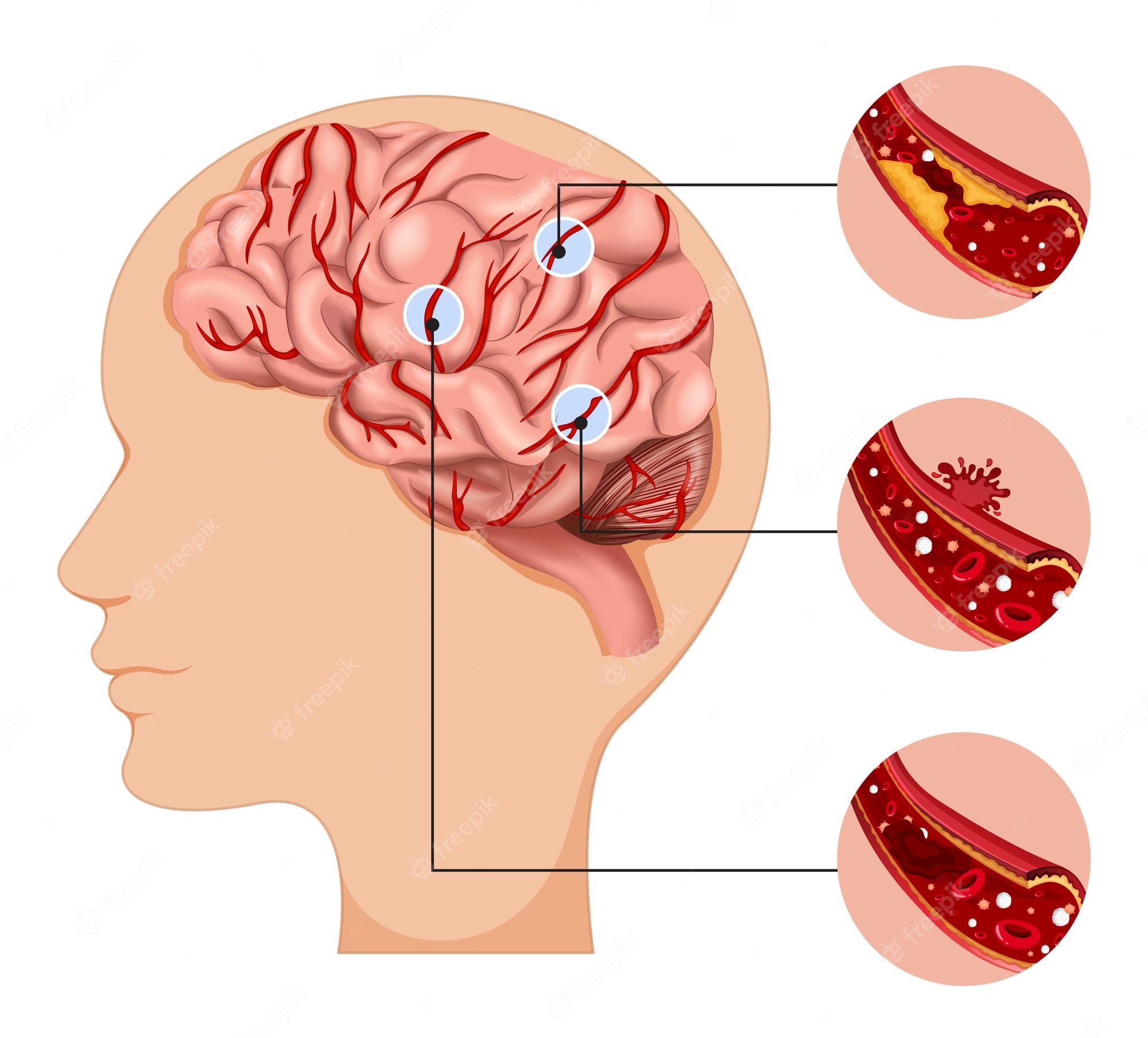 سکته مغزی (Stroke) چیست و چگونه اتفاق می‌افتد: علائم ، علت، درمان، توانبخشی و پیشگیری. درمان در منزل حرکت